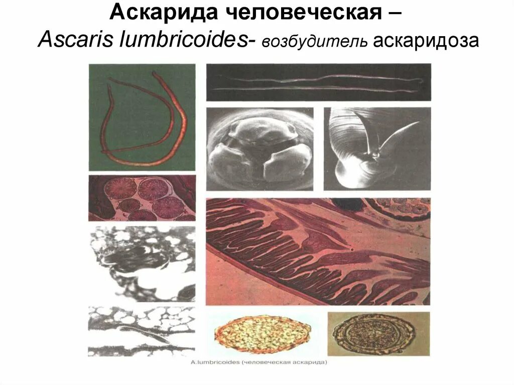 Частый аскаридоз. Частый аскаридоз