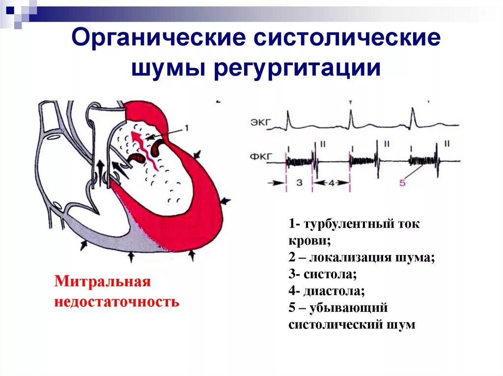 Органические систолические шумы ФКГ. Митральная недостаточность фонокардиограмма. Митральная недостаточность фонокардиография. ЭКГ критерии митральной недостаточности. Систолический шум это