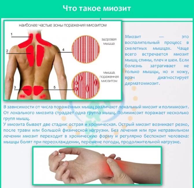 Мышечная миалгия симптомы. Эпидемическая миалгия. Эпидемическая миалгия симптомы. Миалгии при инфекционных заболеваниях. Миалгия симптомы и лечение у женщин.