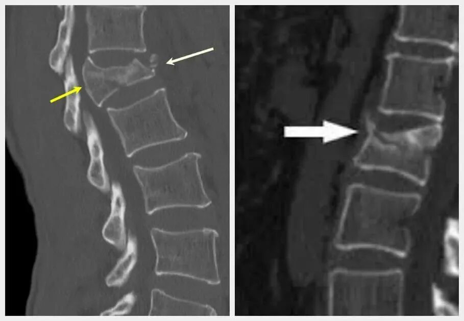 Компрессионный перелом c5 c6. Компрессионный перелом рентген. Остеопороз компрессионный перелом позвоночника. Компрессионный перелом th4 что это такое. Компрессионный перелом тела 1 1