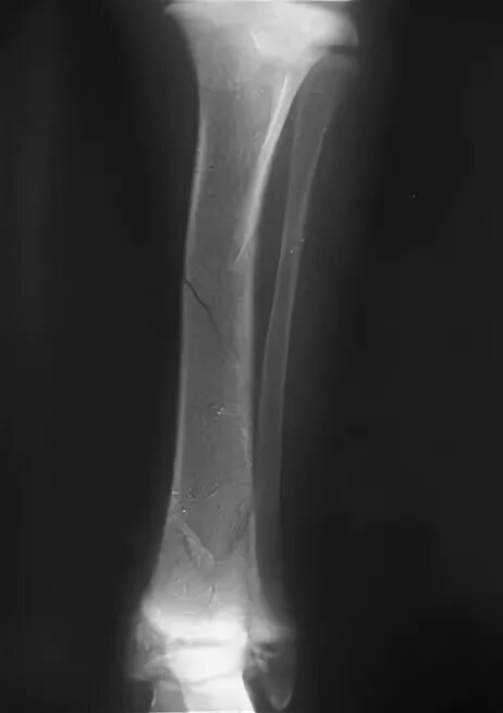 Переломы трубчатых костей рентген. Осложнения переломов трубчатых костей. Полный перелом и неполный перелом рентген. Неполный перелом рентген.