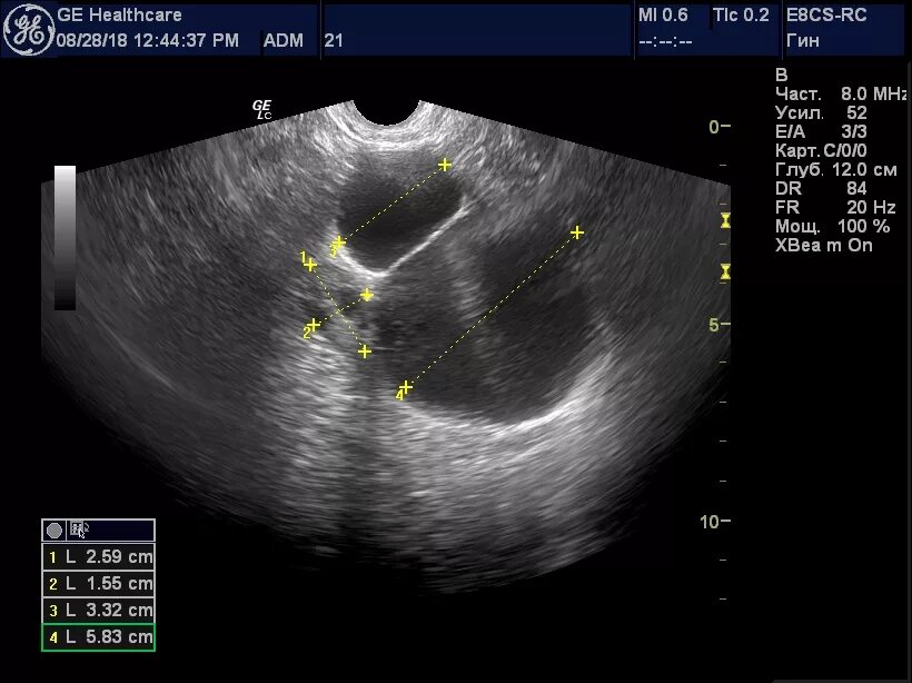 Киста размеры для операции. Параовариальная киста на УЗИ. Эндометриоидная киста яичника на УЗИ. Параовариальные кисты яичников. Лапароскопическая картина апоплексии яичника.