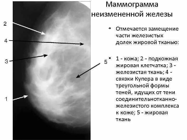 Интрамаммарный лимфоузел молочной железы на маммографии. Квадранты молочной железы рентген. Связка Купера молочной железы анатомия. Анатомия молочной железы маммограмма. Лимфоузел молочной железы маммография