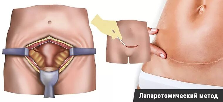 Нижнесрединная лапаротомия. Лапаротомия миомы матки. Лапаротомия экстирпация матки. Лапаротомия лапаротомия матки. Гистерэктомия что это такое простыми