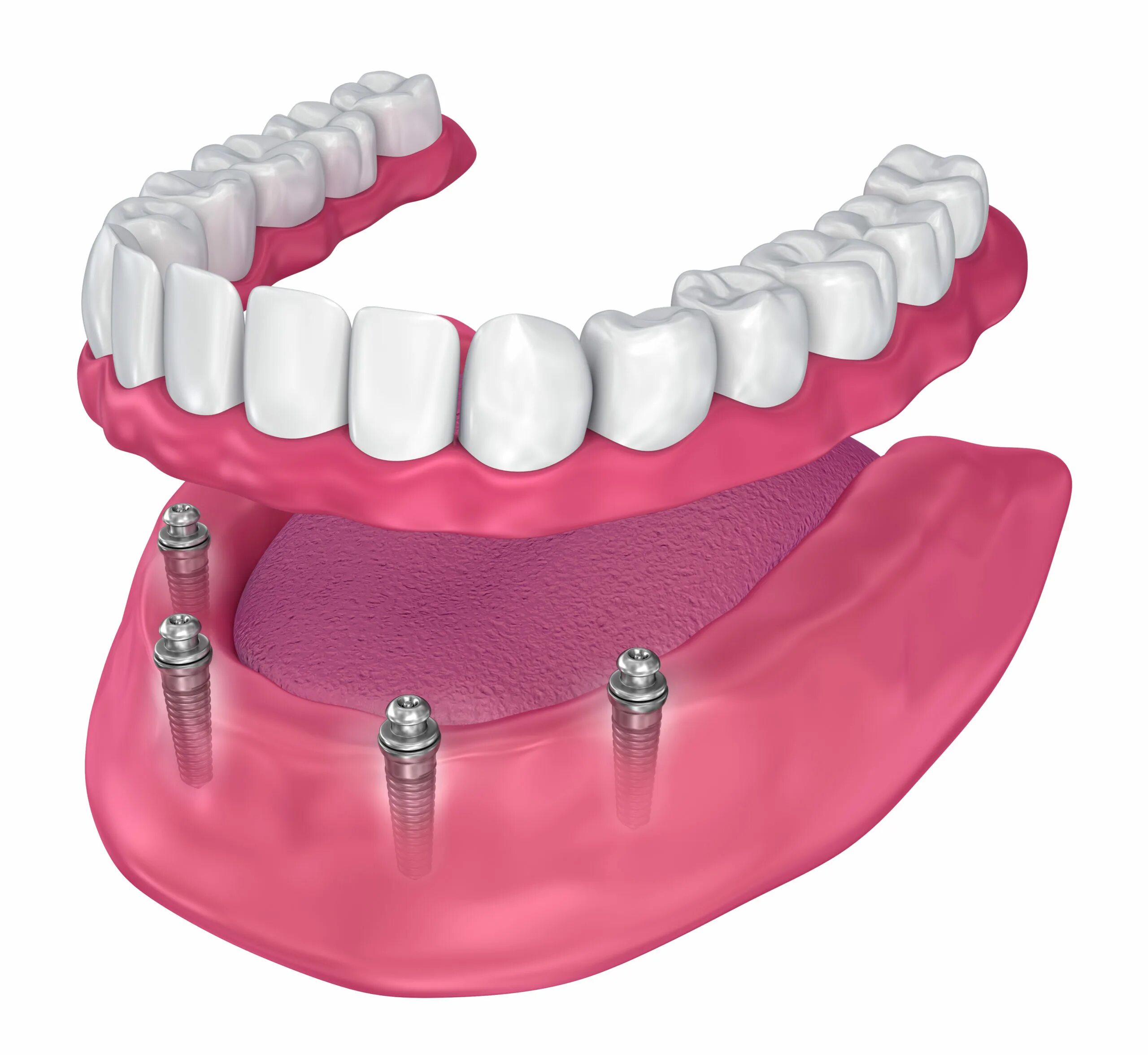 Зубы спб. Балочный протез на 4 имплантах. Имплантологическая кассета Nobel полный набор для all on 4. Несъемные зубные протезы на 4 имплантах.