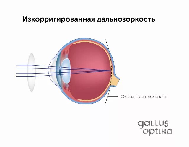 Дальнозоркость форум. Дальнозоркость (гиперметропия). дальнозоркость высокой степени. гиперметропия высокой степени обоих глаз. гиперметропия слабой степени обоих глаз.