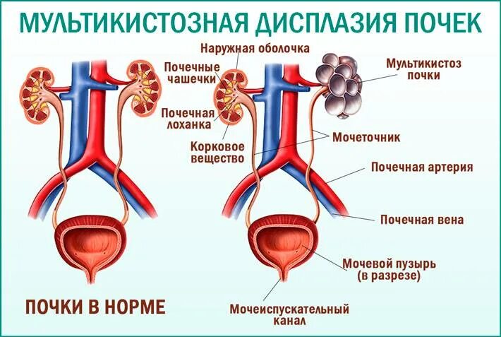 Кистозная дисплазия почек. Дисплазия почек это. Дисплазия почки: а) рудиментарная почка. Мультикистозная дисплазия почки на узи. Дисплазия почек диагностика.