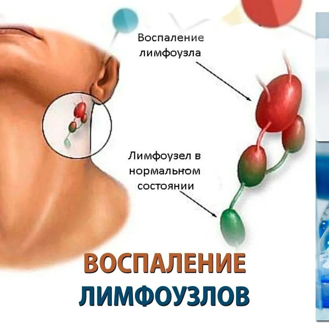 Воспаление лимфоузлов. Лимфоузлы на шее лекарства и препараты