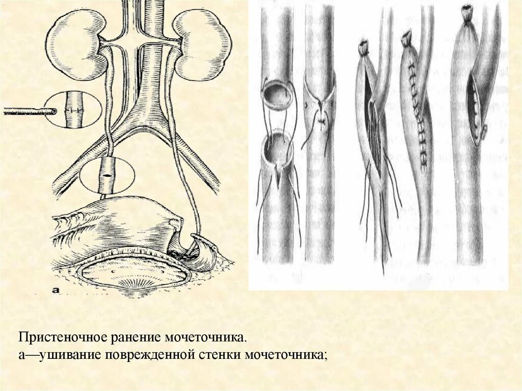 Дилатация мочеточника. Рассечение устья мочеточника. Замыкательный аппарат мочеточника. Эктопия мочеточника перекрестная. Резекция стриктуры мочеточника.