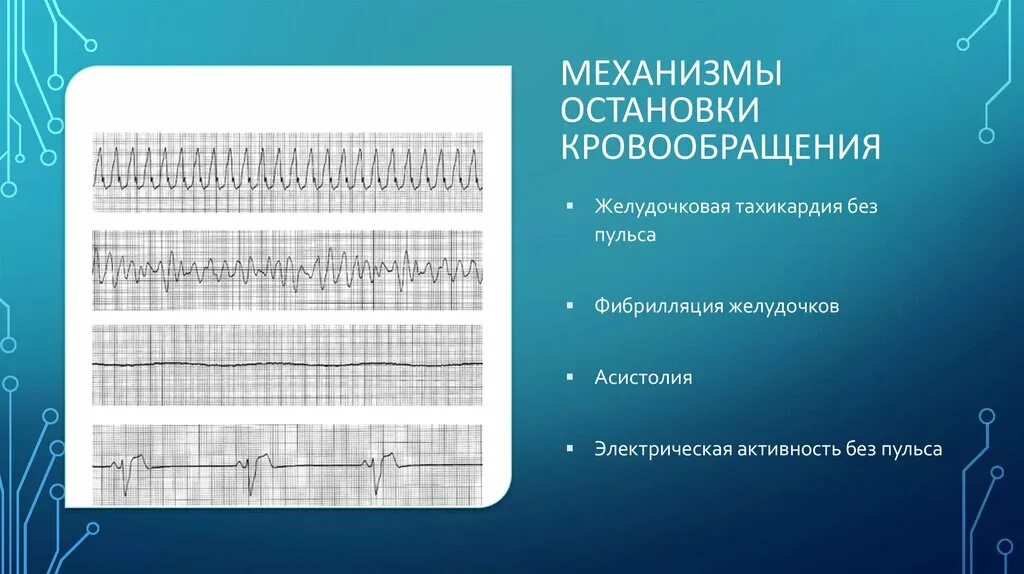 Желудочковая тахикардия без пульса. Электрическая активность сердца без пульса на ЭКГ. Желудочковая тахикардия без пульса на ЭКГ. Фибрилляция желудочков без пульса ЭКГ.