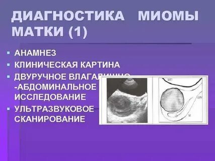 Диагноз миома