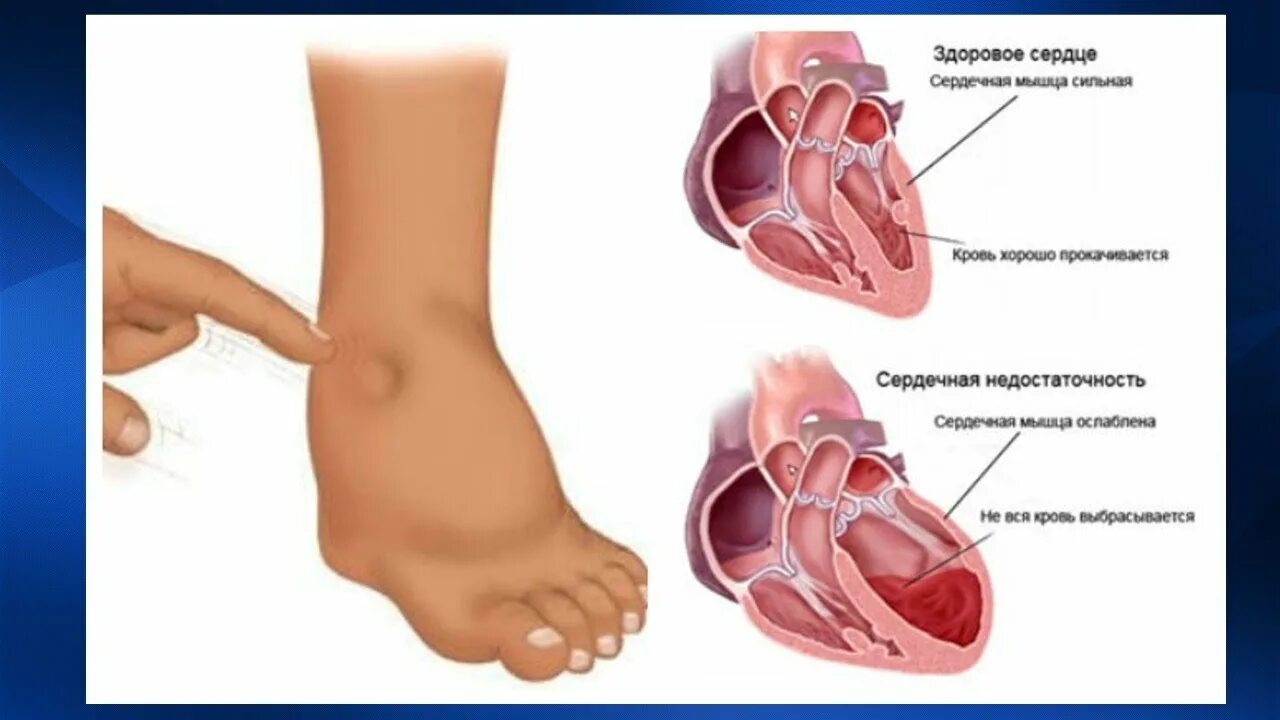 Отеки при хронической сердечной недостаточности. Отеки при заболеваниях сердечно-сосудистой системы.