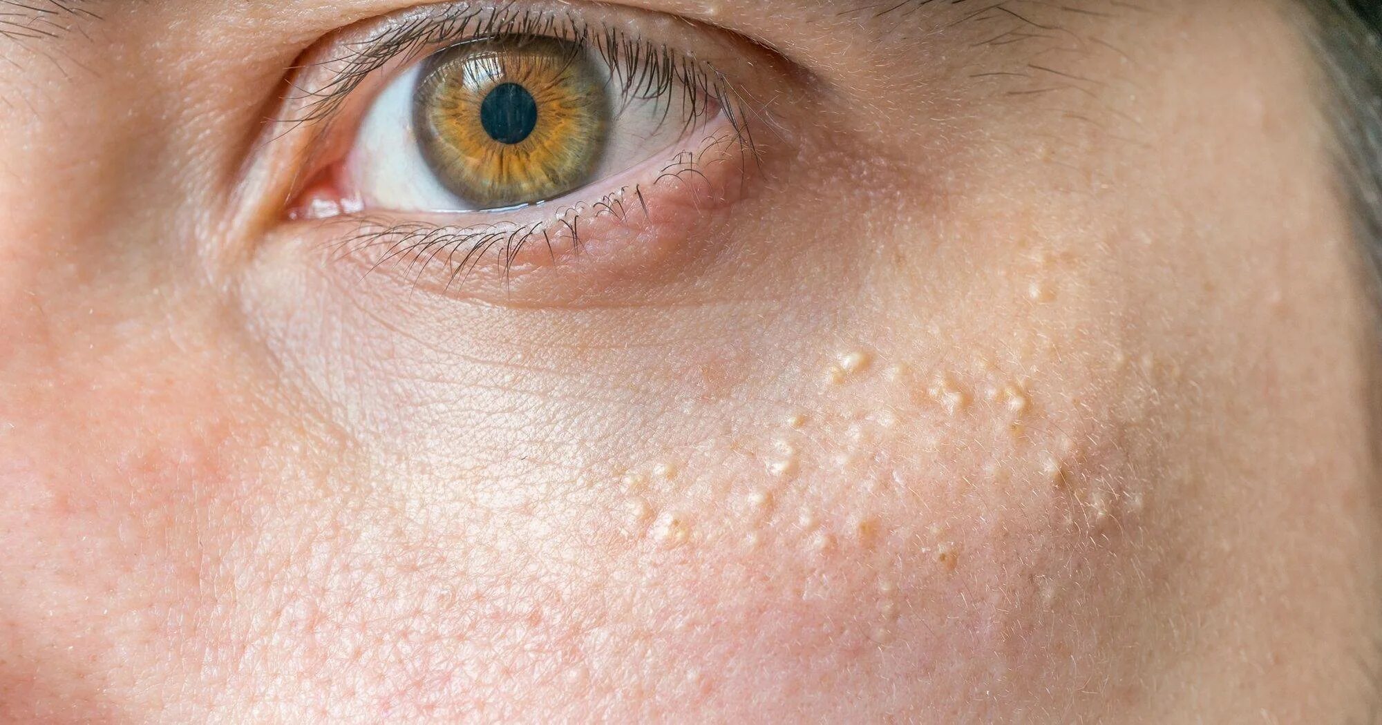 Угревая сыпь, акне, постакне,. Миолипома мягких тканей. Уплотненная кожа. Просянка (белые угри, милиумы). Защип кожной складки живота.