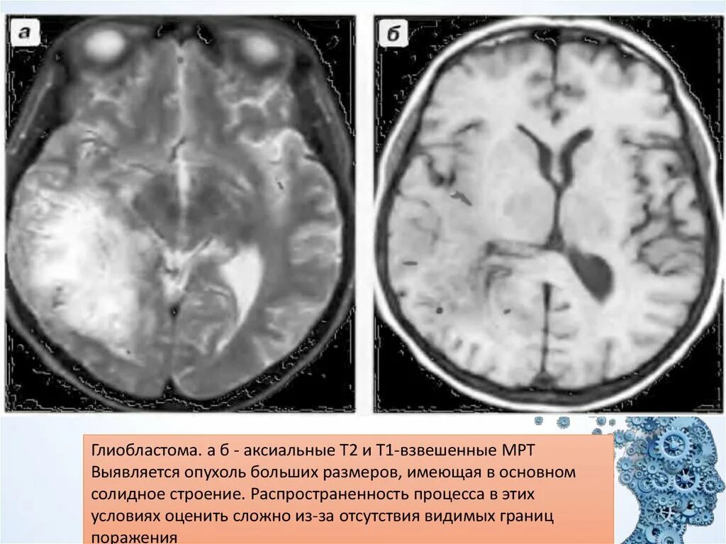 Опухоль головного мозга т1 т2. Кт мозга геперобластома. Глиобластома головного мозга на кт. Мрт глиобластома глиобластома.