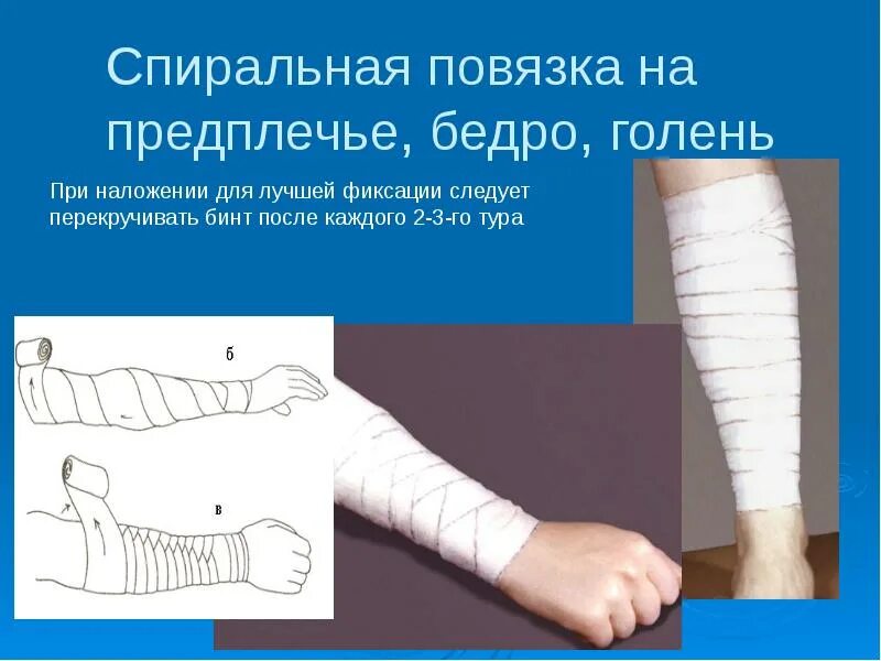 Спиральная повязка техника наложения. Спиралевидная бинтовая повязка. Спиральная повязка на предплечье. Спиральная повязка на голень. Бинтовая повязка на голень.