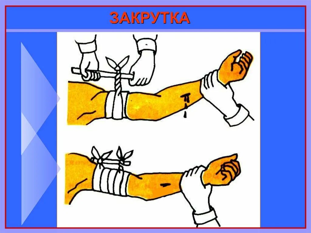 Наложение жгута закрутки. Порядок наложения кровоостанавливающего жгута на конечность. При правильном наложении жгута для остановки кровотечения:. Повязка закрутка. Остановка артериального кровотечения жгутом закруткой.