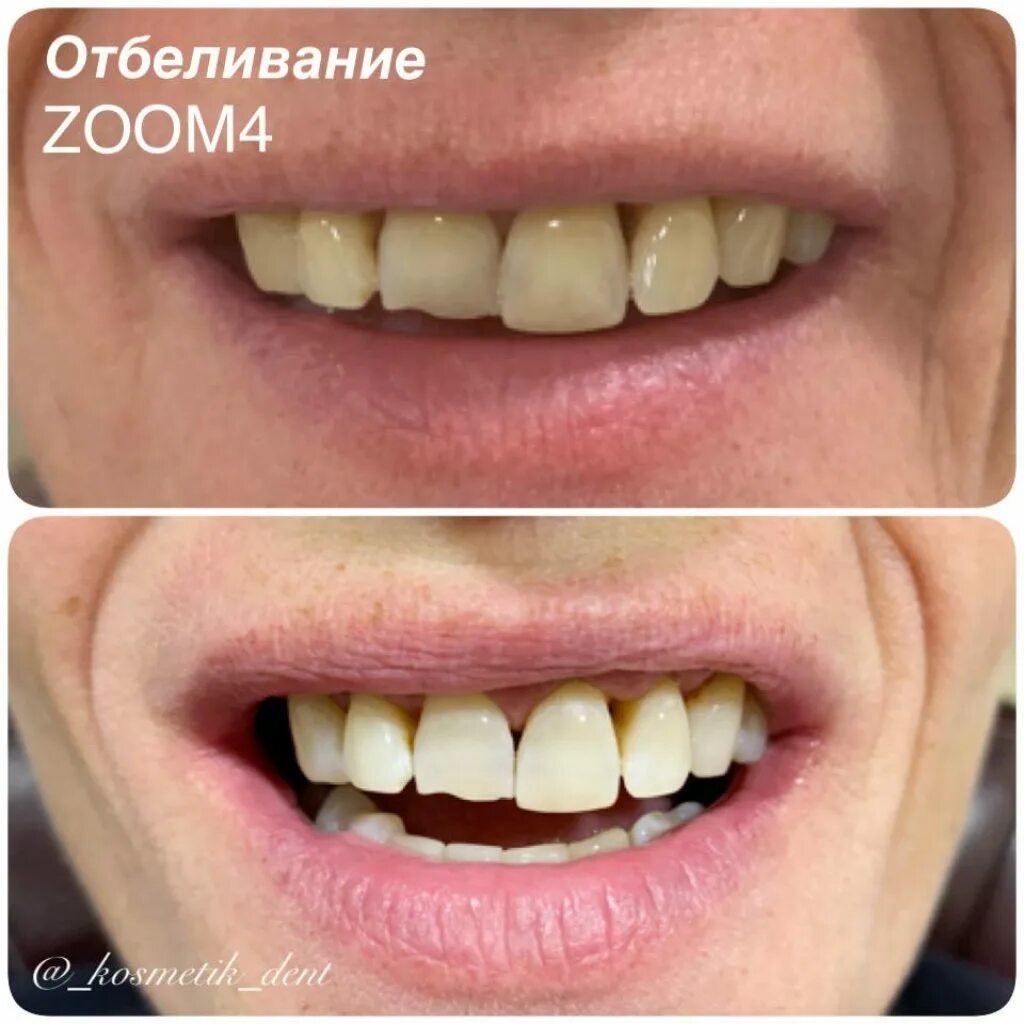 Отбелить передние зубы