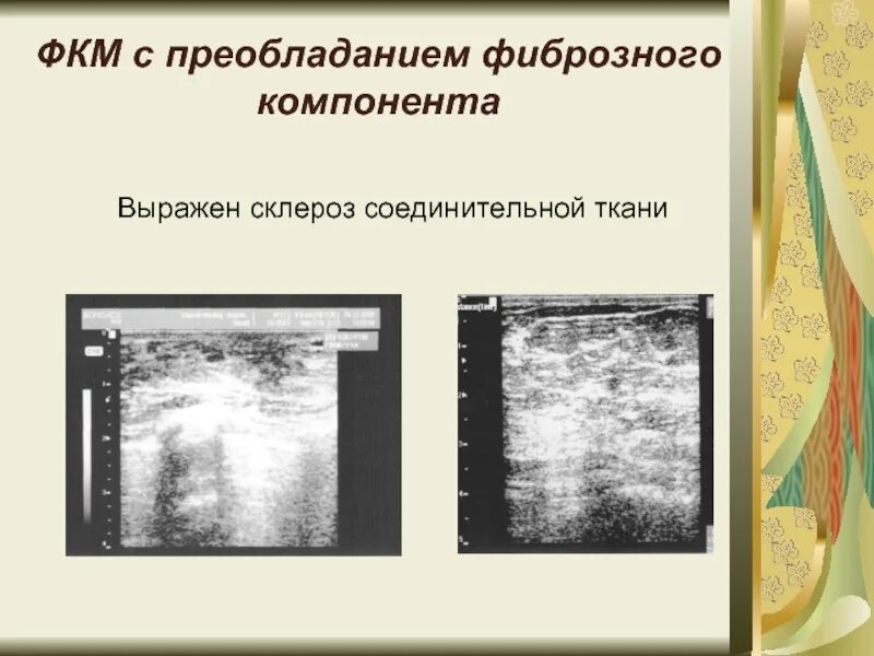 Диффузная мастопатия с преобладанием фиброзного. Фкм с преобладанием фиброзного компонента. фиброзно-кистозная мастопатия с преобладанием фиброза. мастопатия с преобладанием фиброзного компонента. преобладанием фиброзного компонента в молочной железе что это.