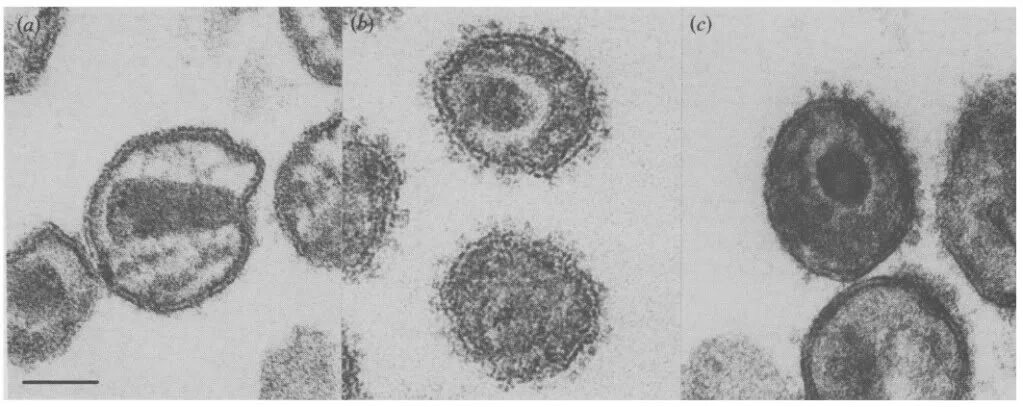 Вич 40. Микрофотография вируса ВИЧ. Вирус ВИЧ под микроскопом. Вирус иммунодефицита под микроскопом. Вирионы ВИЧ под микроскопом.