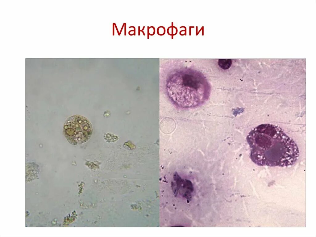 Макрофаги препарат. Пенистые макрофаги гистология. Макрофаги спермограмма микроскопия. Макрофаги цитология. Цитология атлас Макрофаг.