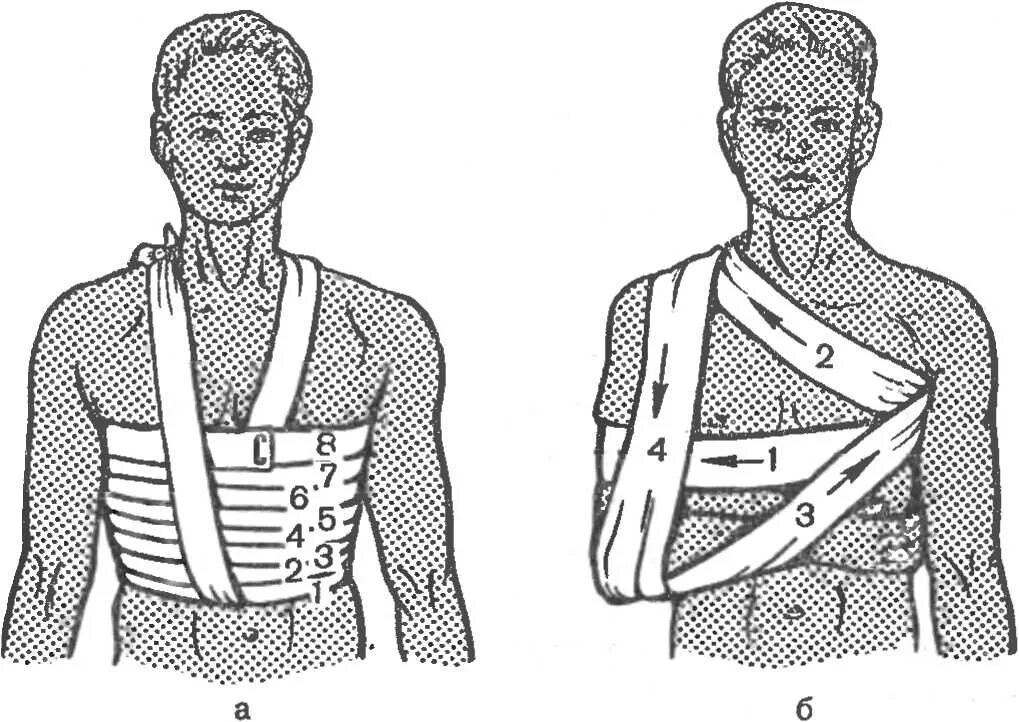 Техника наложения повязок на грудную клетку. Повязка Дезо перелом грудной клетки. Десмургия повязка Дезо. Десмургия повязки на грудную клетку. Наложение повязки Дезо алгоритм.