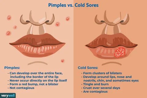 How to Tell the Difference Between a Cold Sore and Pimple.