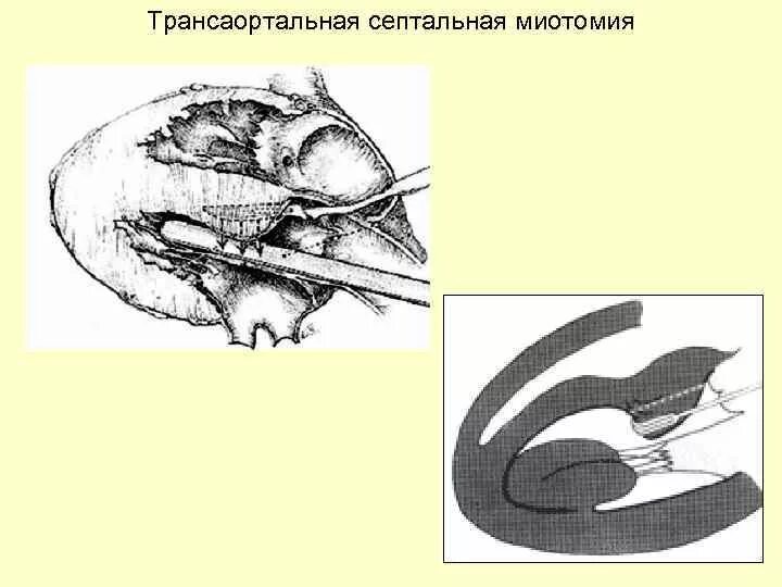 Миоэктомия. Операции при гипертрофической кардиомиопатии. Чрезаортальная септальная миэктомия.