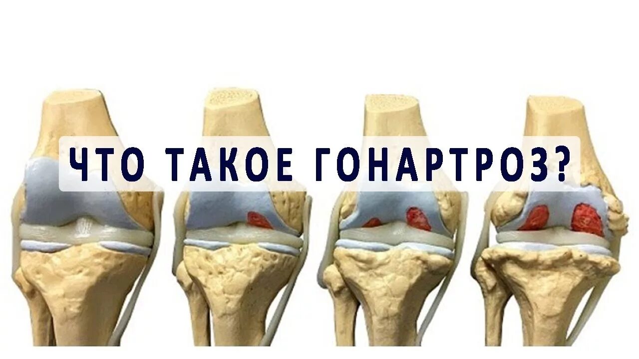 Лечение коленных суставов отзывы пациентов. Артроз коленного сустава. Гонартроз коленного сустава. Артроз коленных суставов (гонартроз).