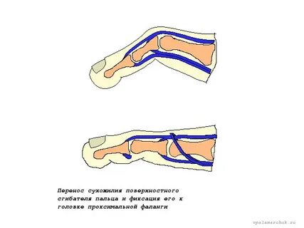 Пластика сухожилия пальца