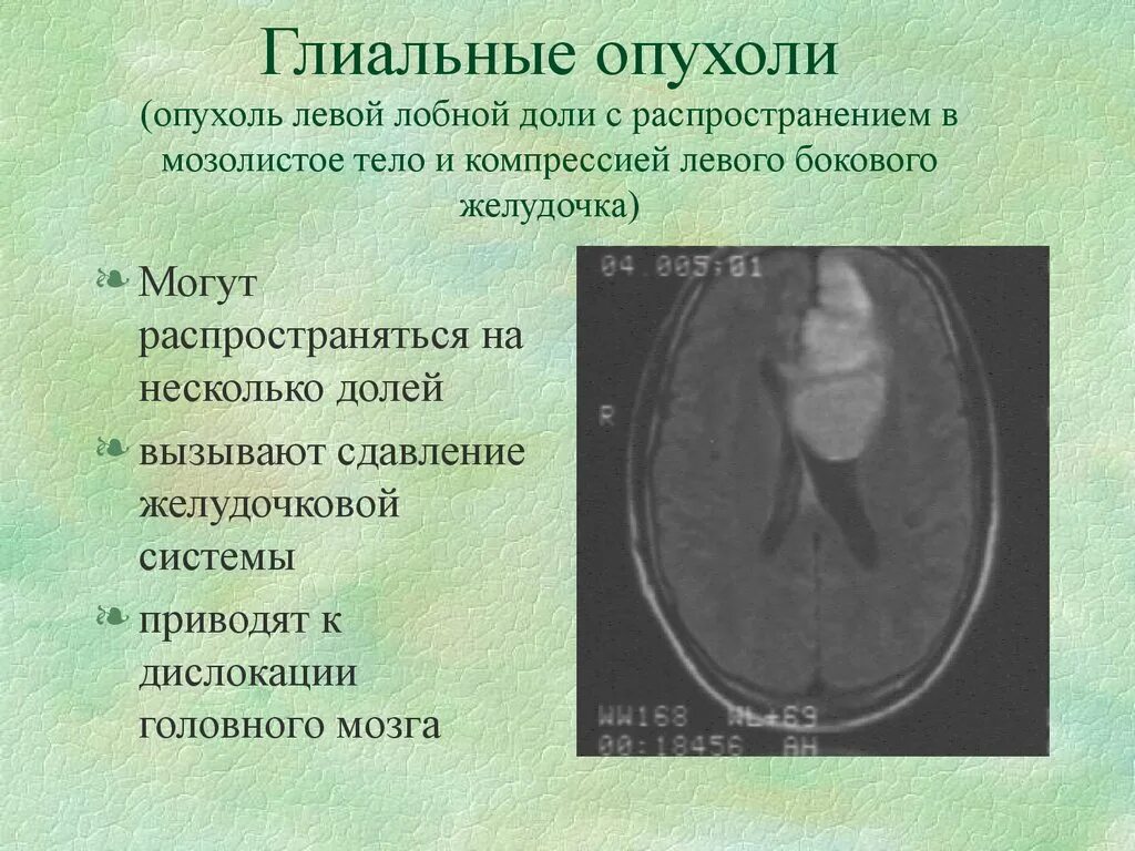 Опухоли боковых желудочков головного мозга. Объемное образование боковых желудочков головного мозга. Опухоль левой лобной доли. Опухоль лобной доли головного мозга. Глиальная опухоль головного