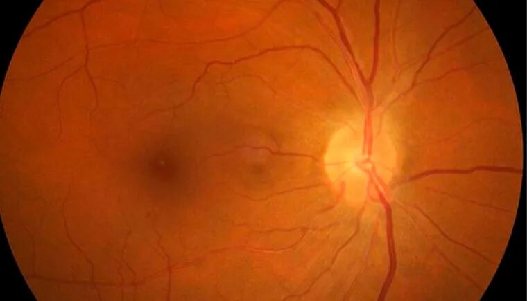 Ангиопатия сосудов головного. Ангиосклероз сетчатки глаза что это такое. Гипертонический ангиосклероз сетчатки. Гипертоническая ретинопатия. Почечная гипертоническая ретинопатия.