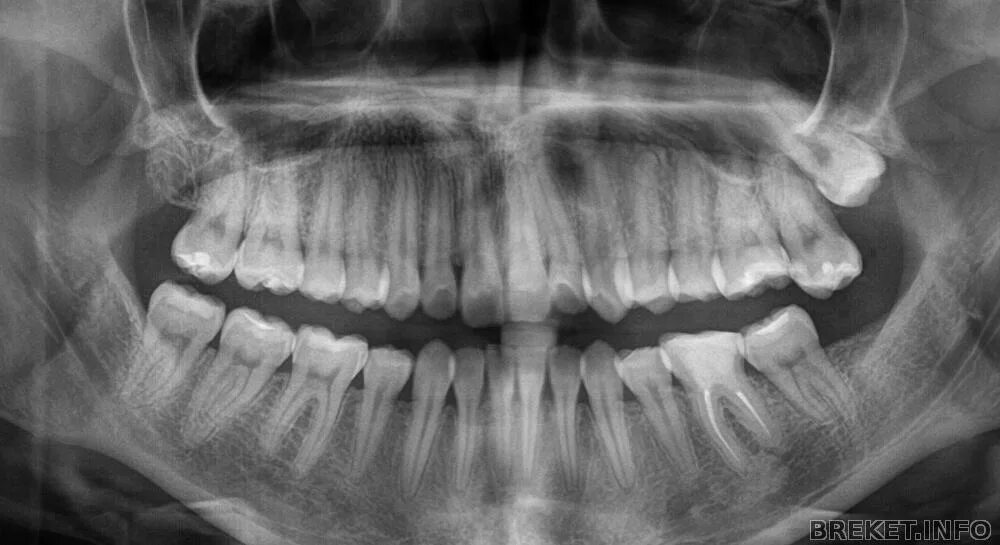 Снимок зубов видное. Рентгенограмма зубов нижней челюсти. ОПТГ снимок зуб мудрости.