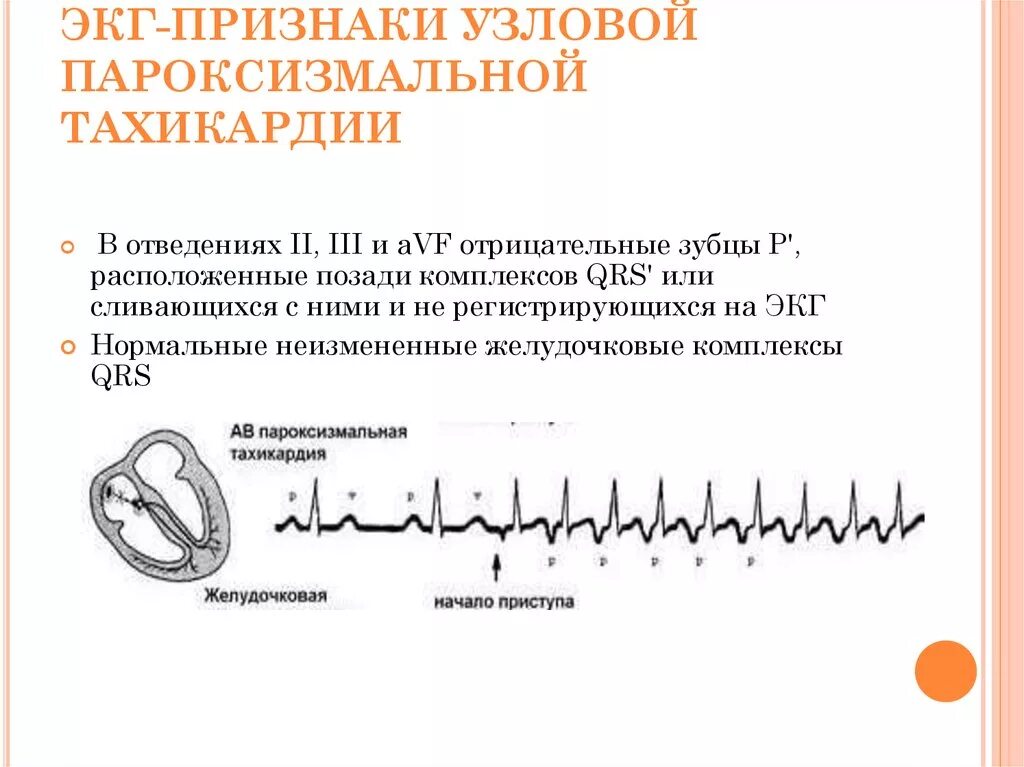 Желудочковая тахикардия на экг. Пароксизмальная желудочковая тахикардия на экг. Экг – критерии пароксизма наджелудочковой тахикардии. Пароксизмальная тахикардия экг признаки. Описание наджелудочковой тахикардии на экг.