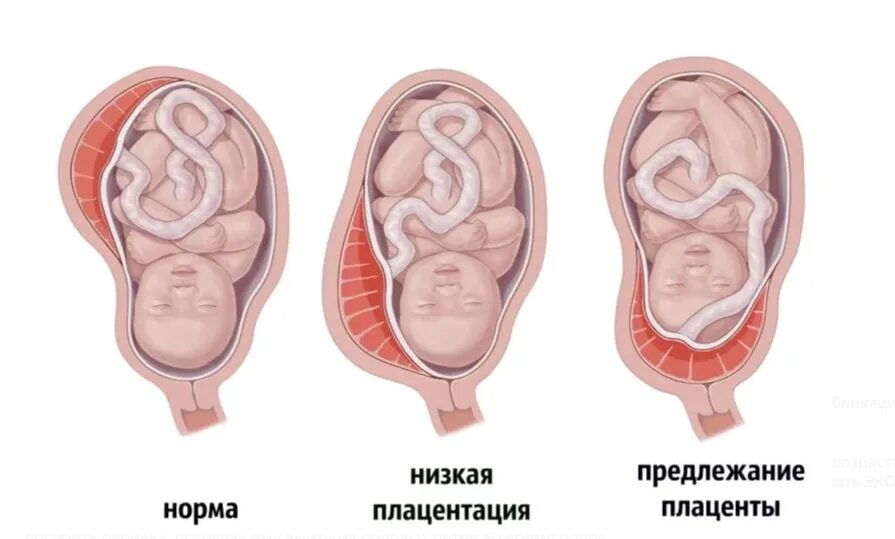 Низкая плацентация это что такое при беременности. Низкая плацента при беременности 26 недель беременности. Низкое предлежание плаценты при беременности 21 неделя. Неполное предлежание плаценты. Перекрытие плаценты внутреннего зева.