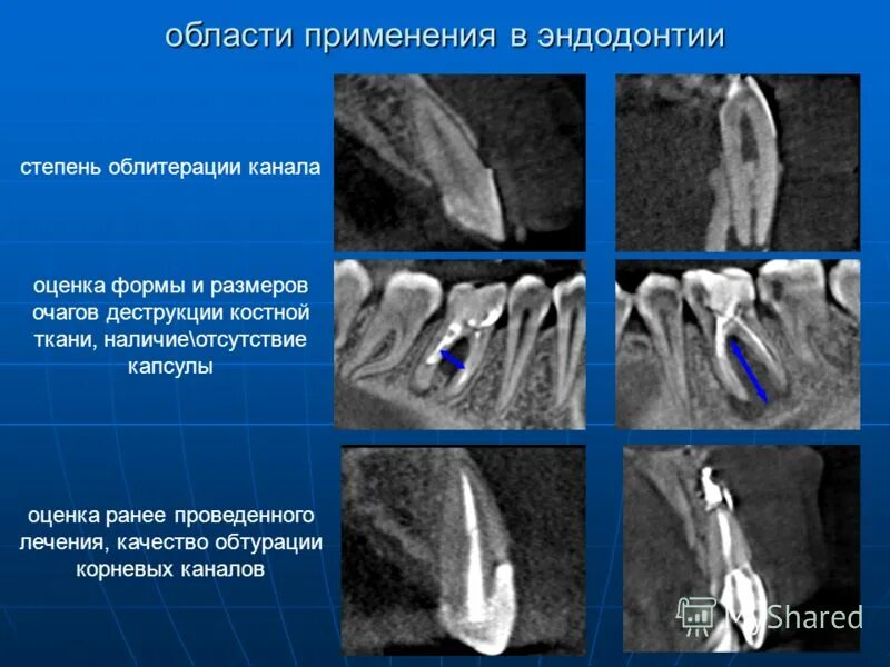 Облитерированные корневые каналы. Облитерация корневых каналов. Облитерация полости зуба. Облитерация зубного канала. Формы корневых каналов