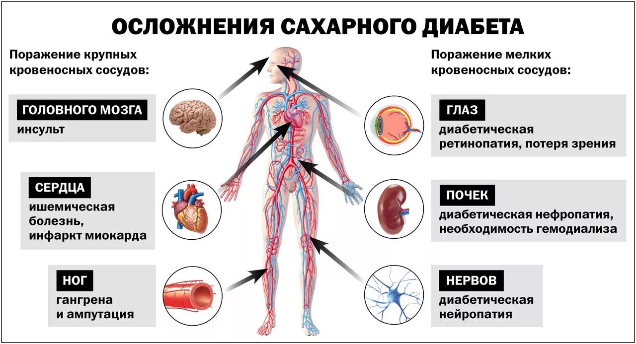 Осложнения СД 1 типа. Профилактика осложнений сахарного диабета. Хронические осложнения СД. Осложнения СД 1 типа и 2 типа. Симптомы и лечение осложнений