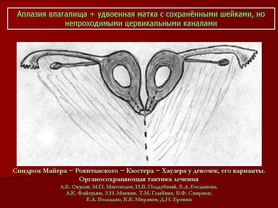 Синдром рокитанского кюстера хаузера. Аномалии яичников и маточных труб. синдром майера рокитанского кюстера. рокитанского кюстнера.
