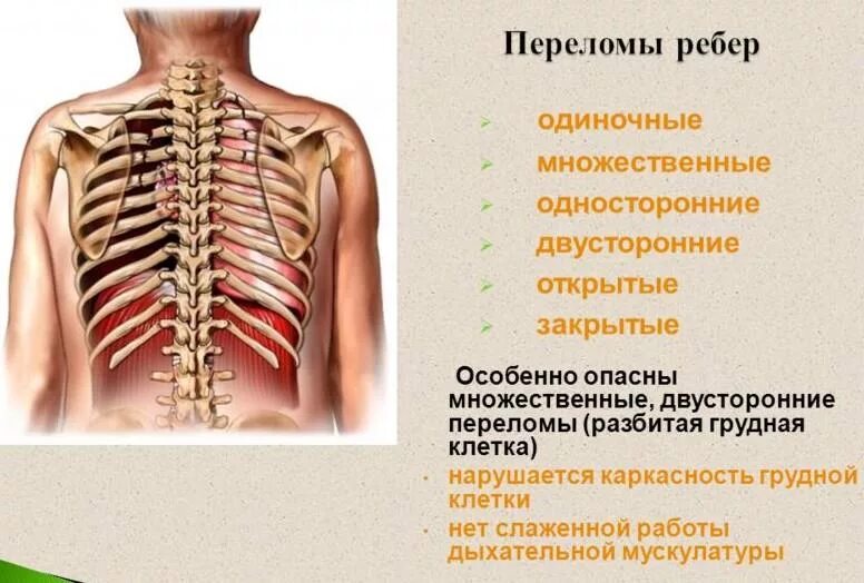 Рентген грудной клетки перелом ребер. Множественные и окончатые переломы ребер. Консолидированный перелом ребра на рентгене. Скелетотопия плевры лёгких. Переломы ребер с захождением отломков.