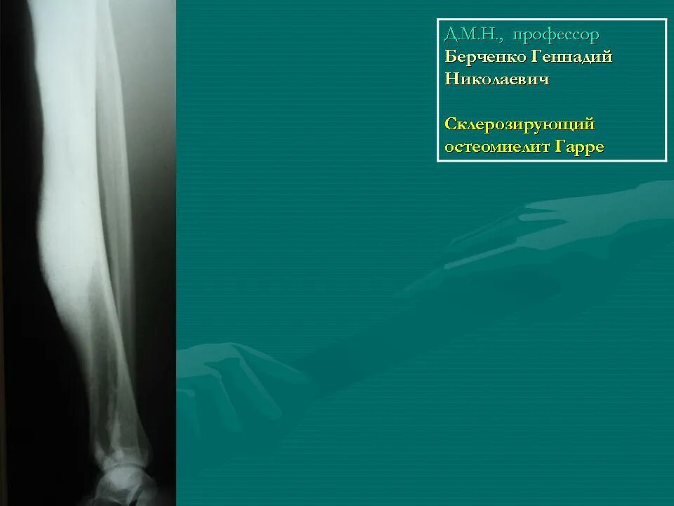Первично хронический остеомиелит рентген. Склерозирующий остеомиелит гарре рентген. Склерозирующий остеомиелит большеберцовой кости. Склерозирующий остеомиелит гарре. Хронический склерозирующий остеомиелит.