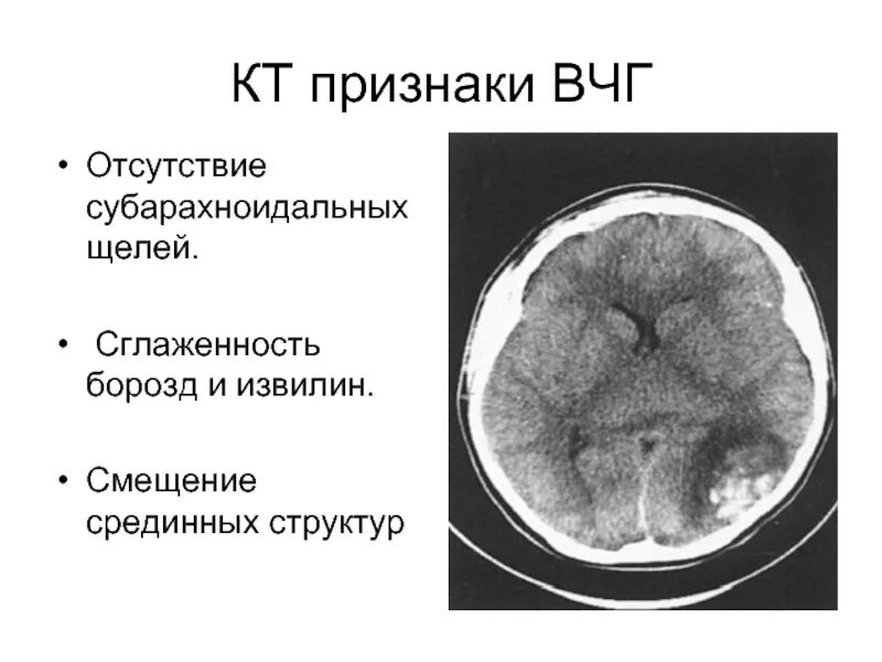 Кт признаки повышения внутричерепного давления. Мрт головного мозга признаки внутричерепной гипертензии. Кт картина внутричерепной гипертензии. Симптомы интракраниальной гипертензии.