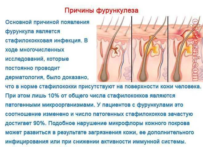 Воспаление канала у мужчин. Фолликулит волосяного фолликула. Покраснение волосяных фолликул. Фолликулит воспаление сальной железы. Стафилококковый фолликулит.