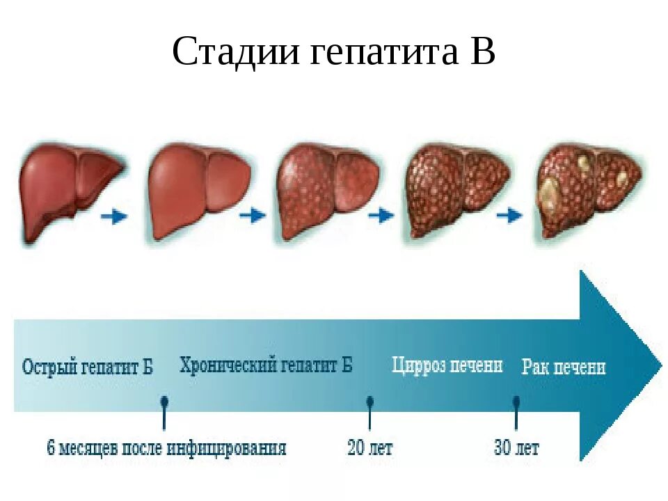 Как лечить гепатит печени