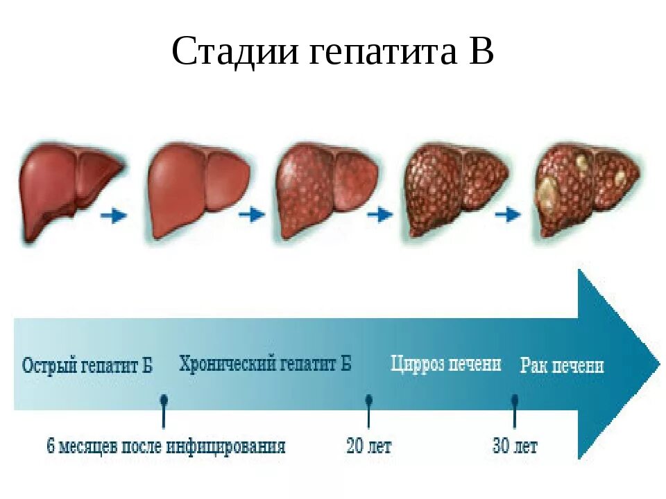 Чем лечить гепатит б. Стадии поражения цирроза печени. Цирроз печени стадии гепатит с. Хронический гепатит б стадии. Цирроз печени при гепатите b.