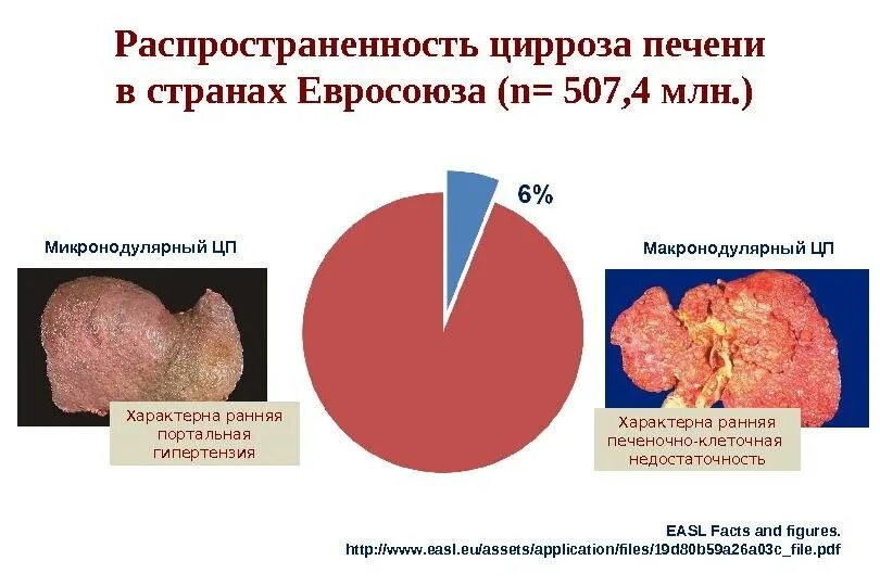 Декомпенсация цирроза. Стадии поражения цирроза печени. телеангиэктазия цирроз печени. схема основных клинических проявления цирроза печени. цирроз печени распространенность.