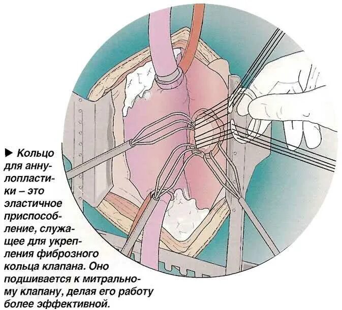 Сколько длится операция по замене клапана. Аннулопластика митрального клапана опорным кольцом мединж-30. опорное кольцо митрального клапана мединж мединж. пластика митрального клапана на опорном кольце мединж. аннулопластика митрального клапана операция.