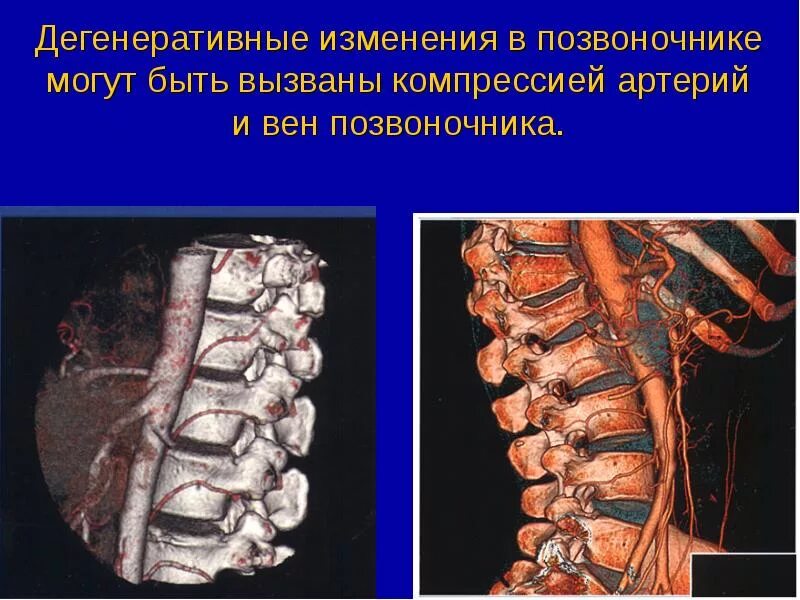 Дистрофические изменения позвоночника. Дегенеративные дистрофические дистрофические изменения. Дегенеративно дистрофические изменения отдела позвоночника. Дегенеративно-дистрофические изменения l2 l3. Дегенеративно-дистрофические изменения шейного отдела.