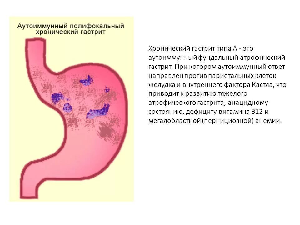 Фундальный атрофический гастрит. Хронический атрофический гастрит синдромы. Хронический атрофический гастрит типа а. Хронический фундальный гастрит. Аутоиммунный гастрит клинические