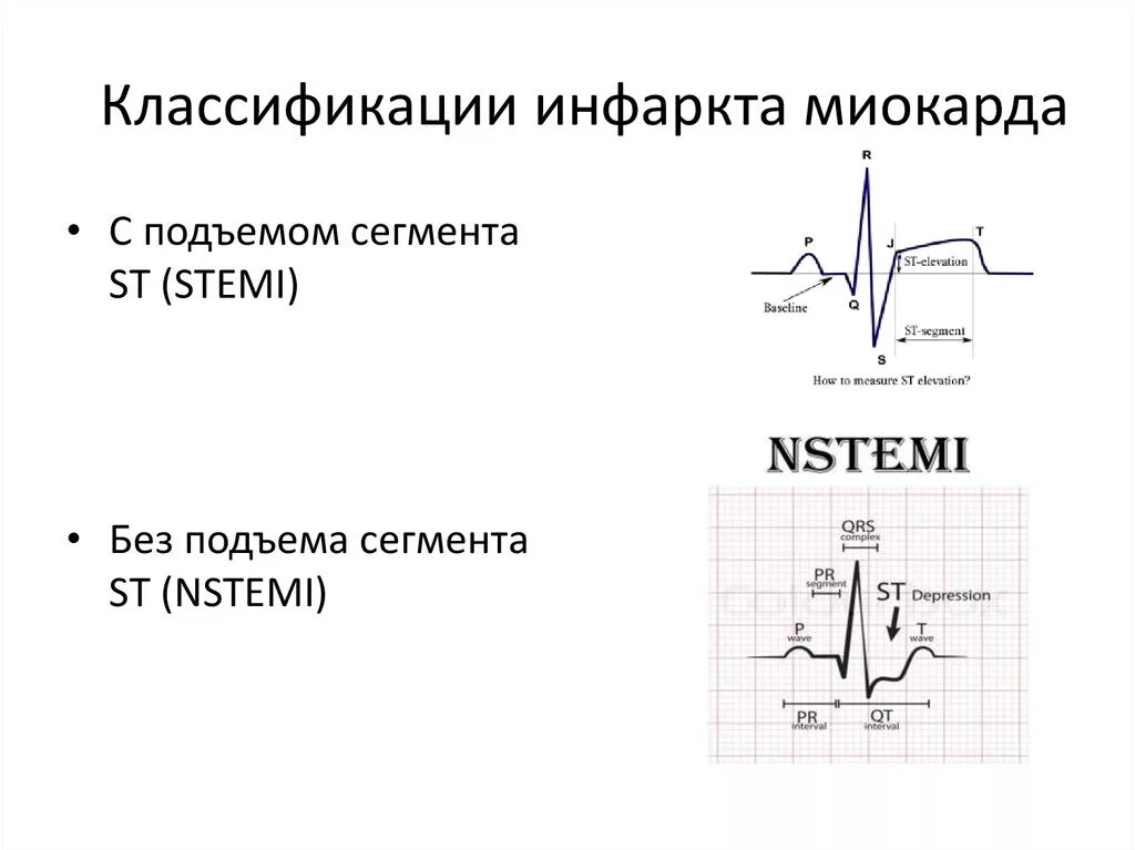 Экг подъем. ЭКГ инфаркт миокарда без подъема St. Инфаркт миокарда на ЭКГ С подъемом ст. ЭКГ при инфаркте миокарда без подъема сегмента St. Инфаркт миокарда с подъемом сегмента St ЭКГ.