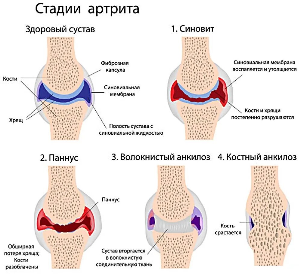 Вода при артрите. Ревматоидный артрит классификация коленный сустав. Ревматоидный паннус микропрепарат.