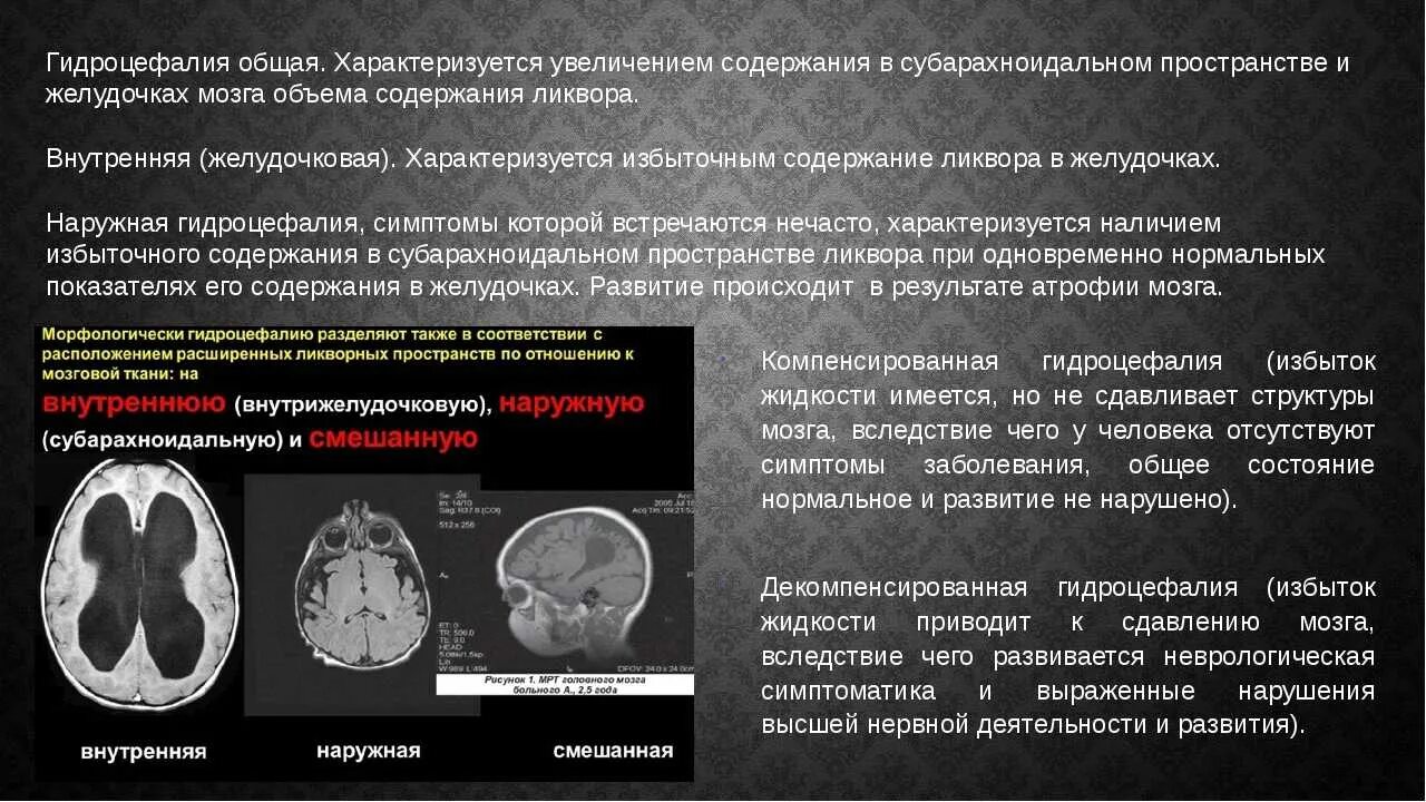 Диффузные изменения головного мозга. Заместительная наружная гидроцефалия кт. гидроцефалия кт признаки. гидроцефалия головного мозга на кт. наружная внутренняя гидроцефалия мрт.